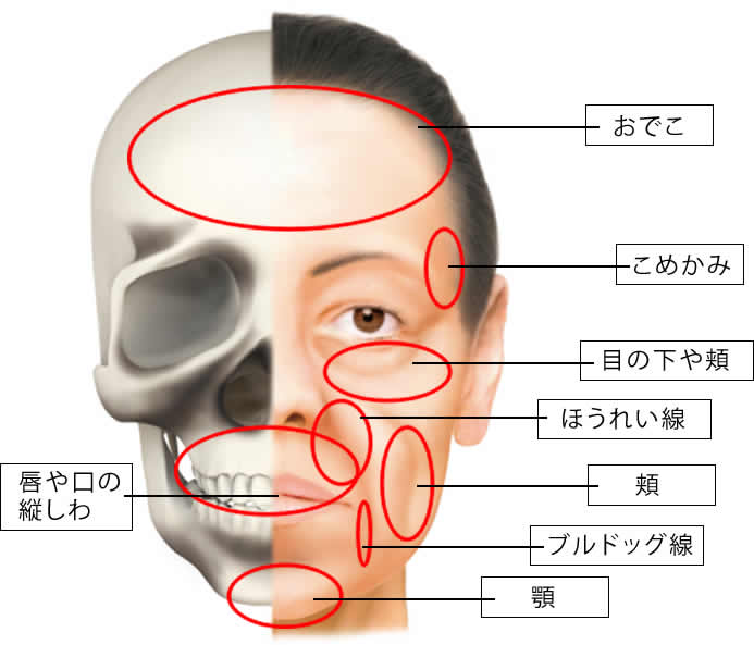 ヒアルロン酸を入れる部位